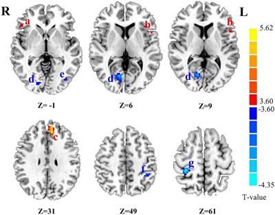 Cognitive Deficit and Aberrant Intrinsic Brain Functional Network in Early-Stage Drug-Naive Parkinson’s Disease